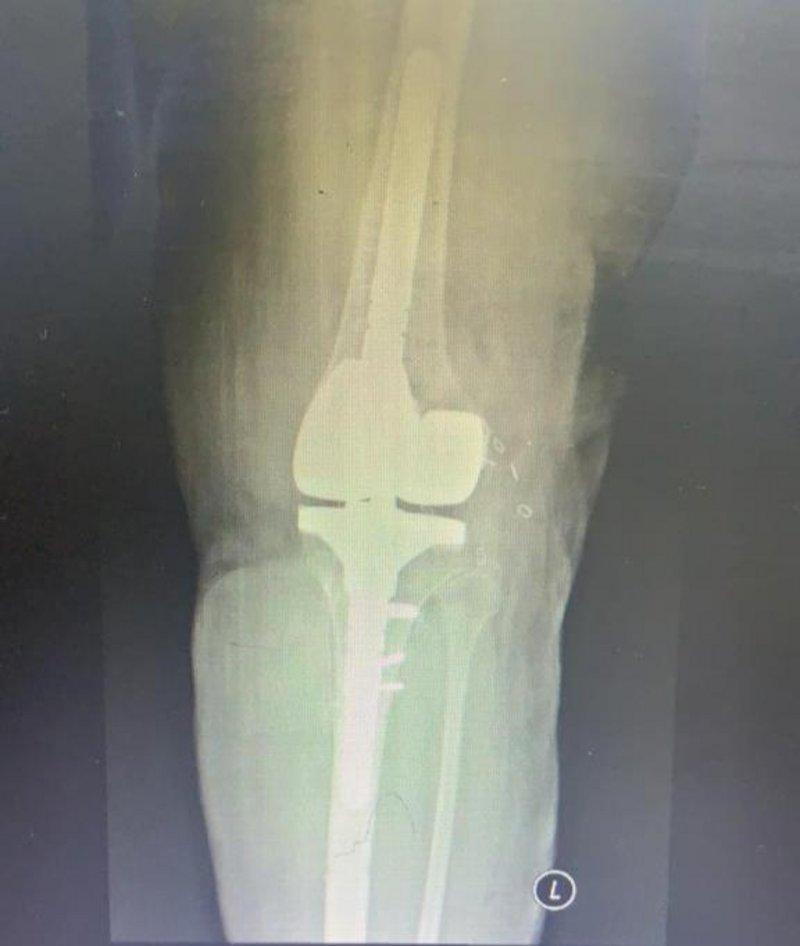 artificial knee joint2