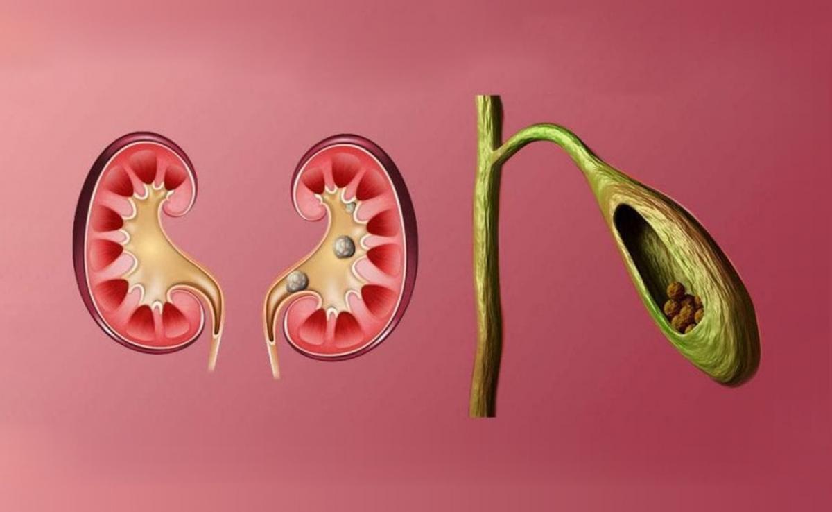 4 Differences between gallbladder and kidney stones